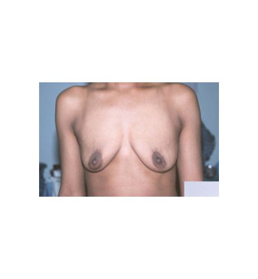 Post Partum Breast Involution Before